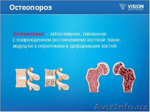 БАД ОстеоСанум (OsteoSanum). Остеопороз костей - симптомы. Препараты для укрепле #1056485