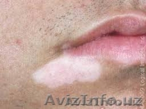 ОК ДОГЛАРНИ (Витилиго)  даволашда вакт билан синалган-махсулот!!!  #1140403