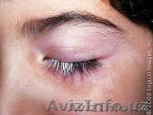 Лечение белых пятен на коже Витиксом эффектисность проверен временем!! #1140369