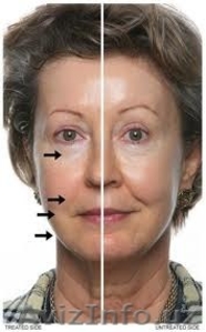 Ажинларига карши самарали янги махсулотни  кулланг ва ёшариб курининг!!! #1140380