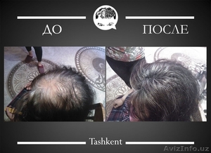 Избавься от залысин и редких волос за 30 секунд! #1172510