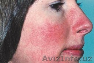 Хуснбузарлар (пушти),  демодекоз,  каткалокли дерматит ва юз кизаришига #1140389