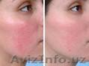 Угри -розовые и их  лечение  #1140390