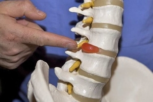 Лечение грыж!!! #1680666