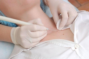 Удаление папиллом в медицинской клинике. Врач дерматолог косметолог. #1707712